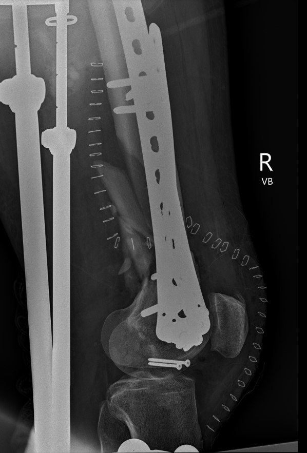 Complex distal femur 2